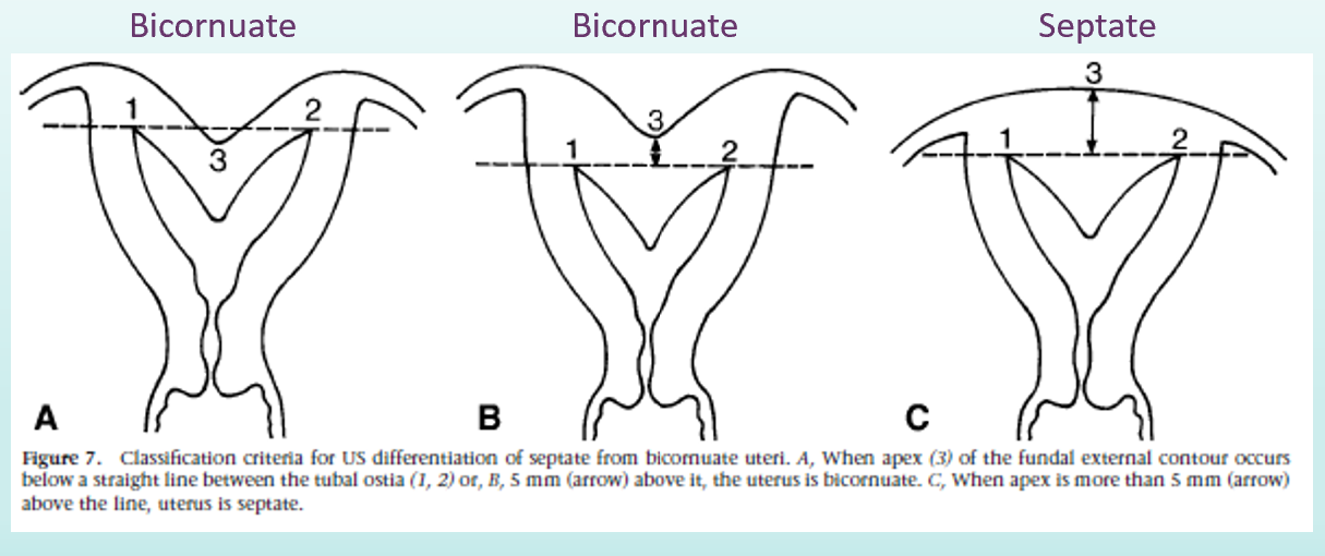 <ul><li><p>evaluate fundal notch— outer contour (this is what is heart shaped in a bicornuate uterus)</p></li><li><p>no notch is seen with septate uterus!</p></li></ul>