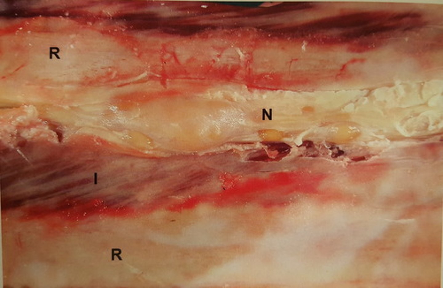 <p>Intercostalnerver hos okse. Patoanatomisk diagnose?</p><p>R=ribben, N=nerver, I=muskulatur</p>