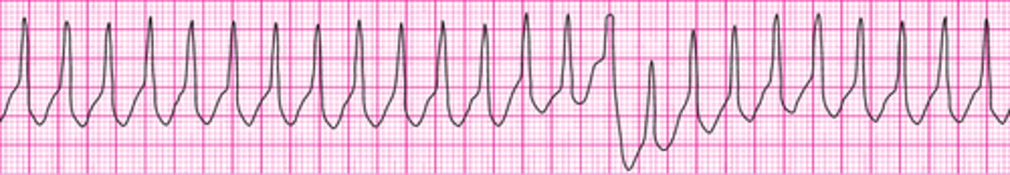 <p>Wide complex tachycardia - version 2</p>