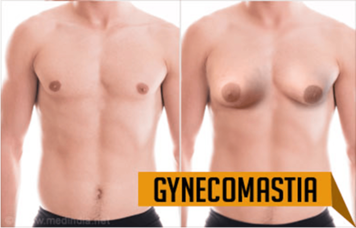 <p>a. During adolescence, it is common for breast tissue to temporarily enlarge.</p><p>b. May reappear in aging male and may be due to testosterone deficiency.</p><p>c. Reassurance is necessary for adolescent male, whose attention is riveted on his body image.</p><p>•Feels like a smooth, firm, movable disk</p><p>**Usually temporary**</p>