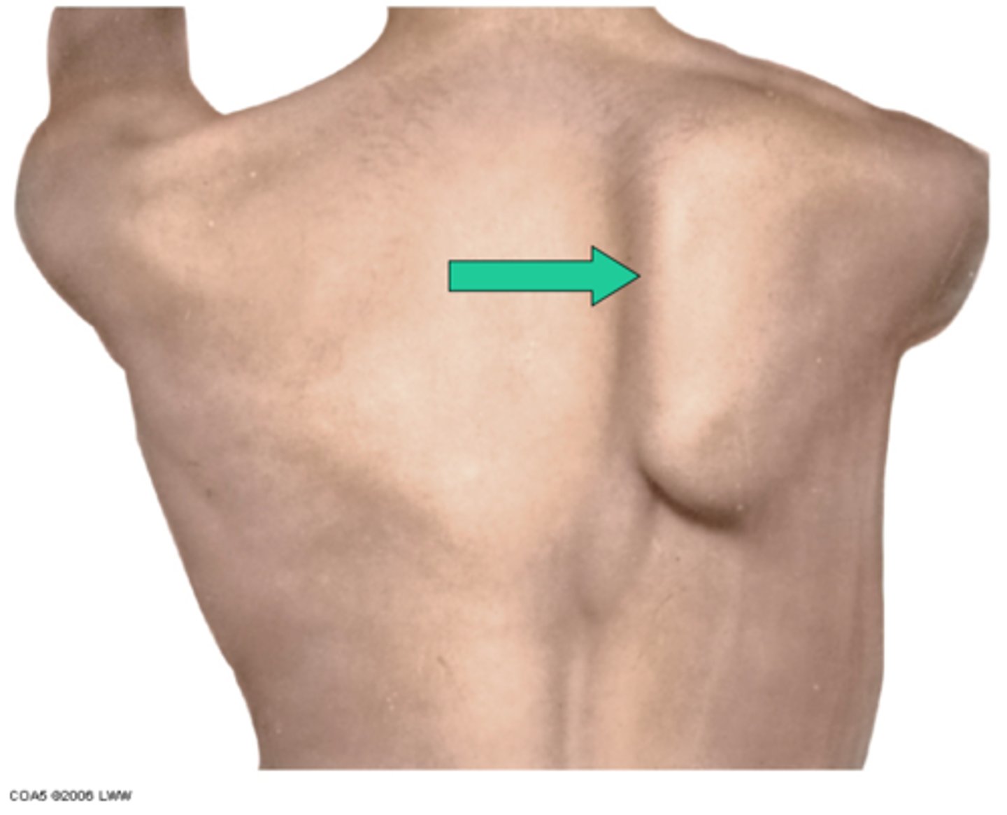 <p>Winged Scapula</p>