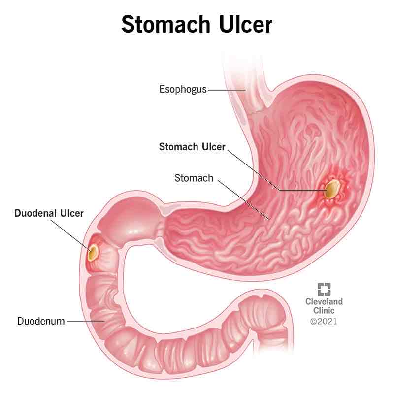 <p>Lesion on the wall of the stomach (peptic ulcer)</p>