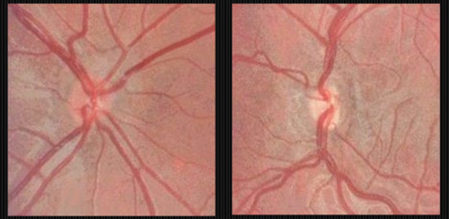 <p>subnormal axons</p><p>normal mesodermal glial elements</p>