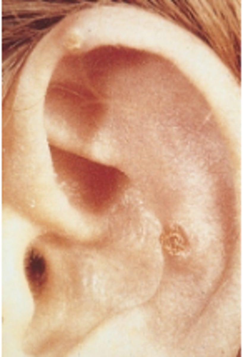 <p>small lumps on helix and additional areas</p>