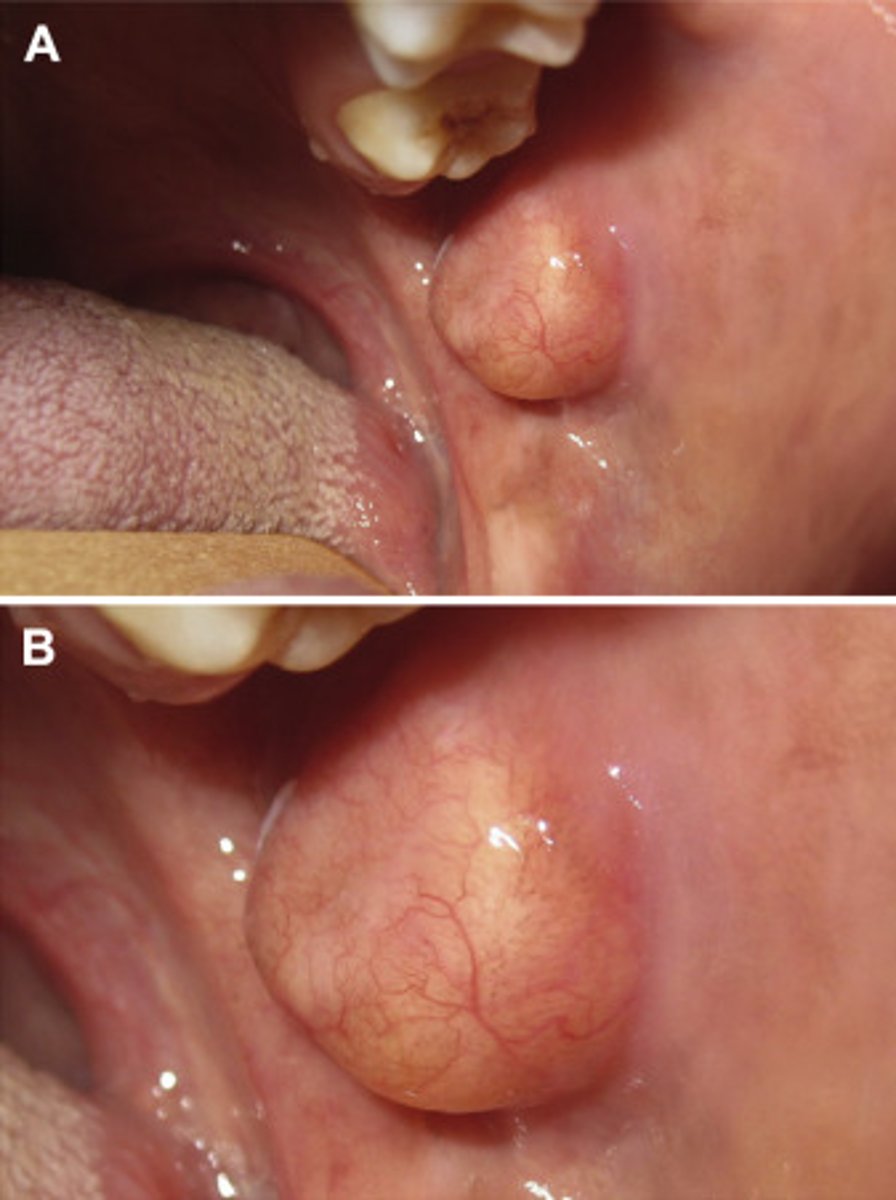 <p>A patient presents with soft, yellowish, smooth mass on the buccal mucosa. The lesion is asymptomatic and slow-growing.</p><p>What is the most likely diagnosis?</p>