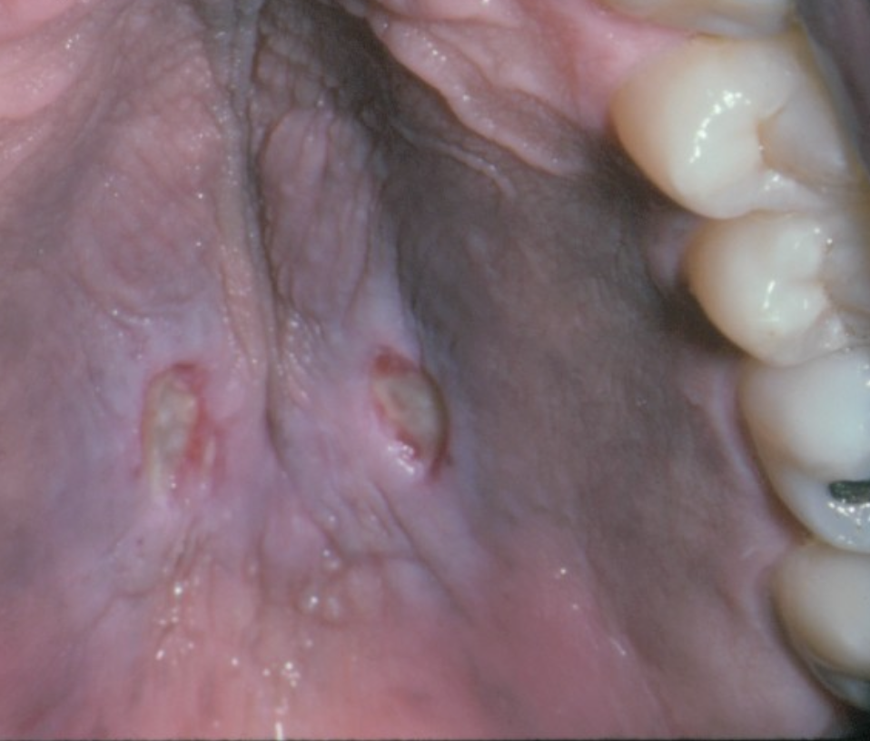 <p>Where does necrotizing sialometaplasia most commonly occur?</p>