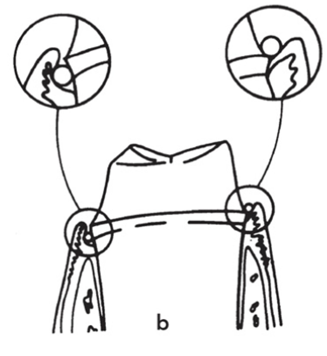 <p>Is the placement of this retraction cord in the sulcus acceptable?</p>