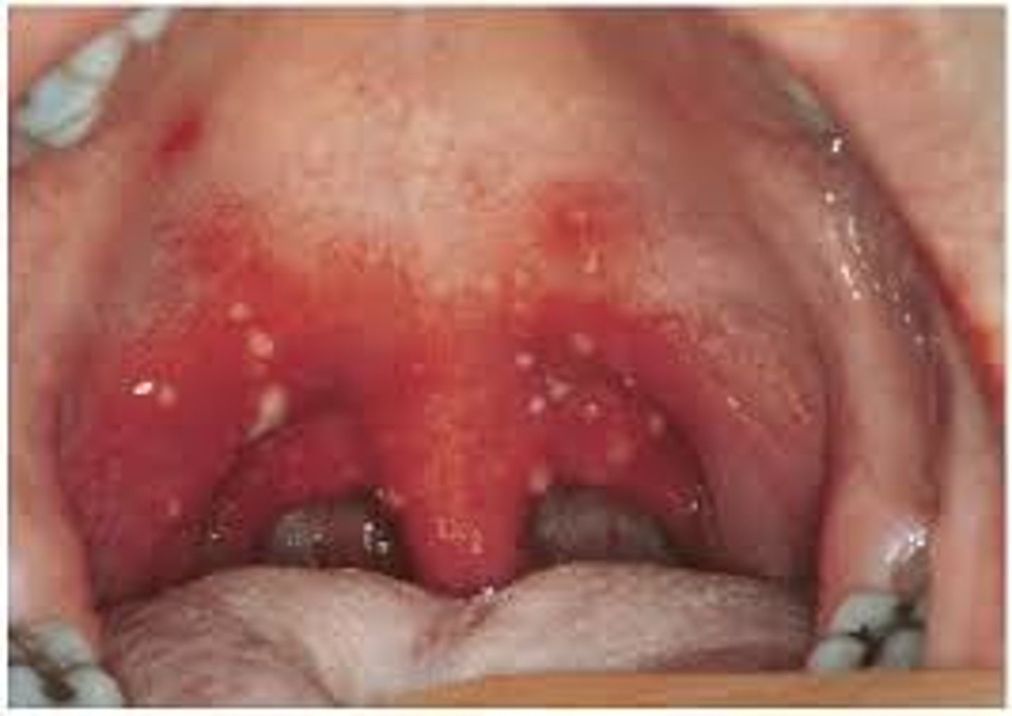 <p>Nagayama spots are erythematous papules on the soft palate and uvula, commonly seen in roseola infantum (exanthem subitum), caused by human herpesvirus 6 (HHV-6). They typically appear during the febrile phase or shortly before the onset of the rose-colored maculopapular rash.</p>