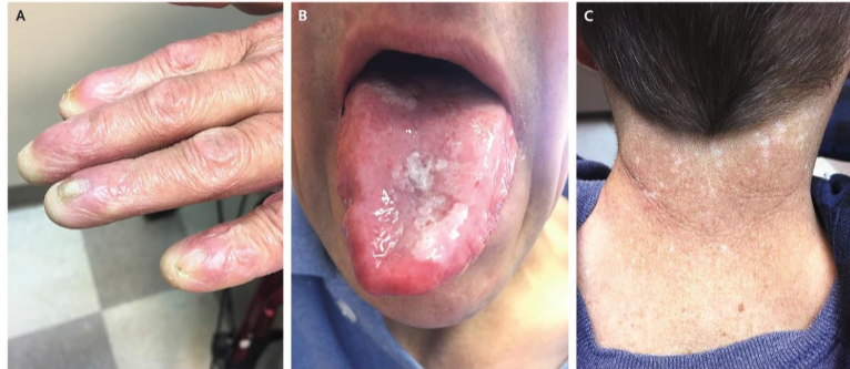 <ol><li><p>nail dystrophy&nbsp;</p></li><li><p>mucosal leukoplakia&nbsp;</p></li><li><p>hyperpigmentation&nbsp;</p></li></ol><p></p>