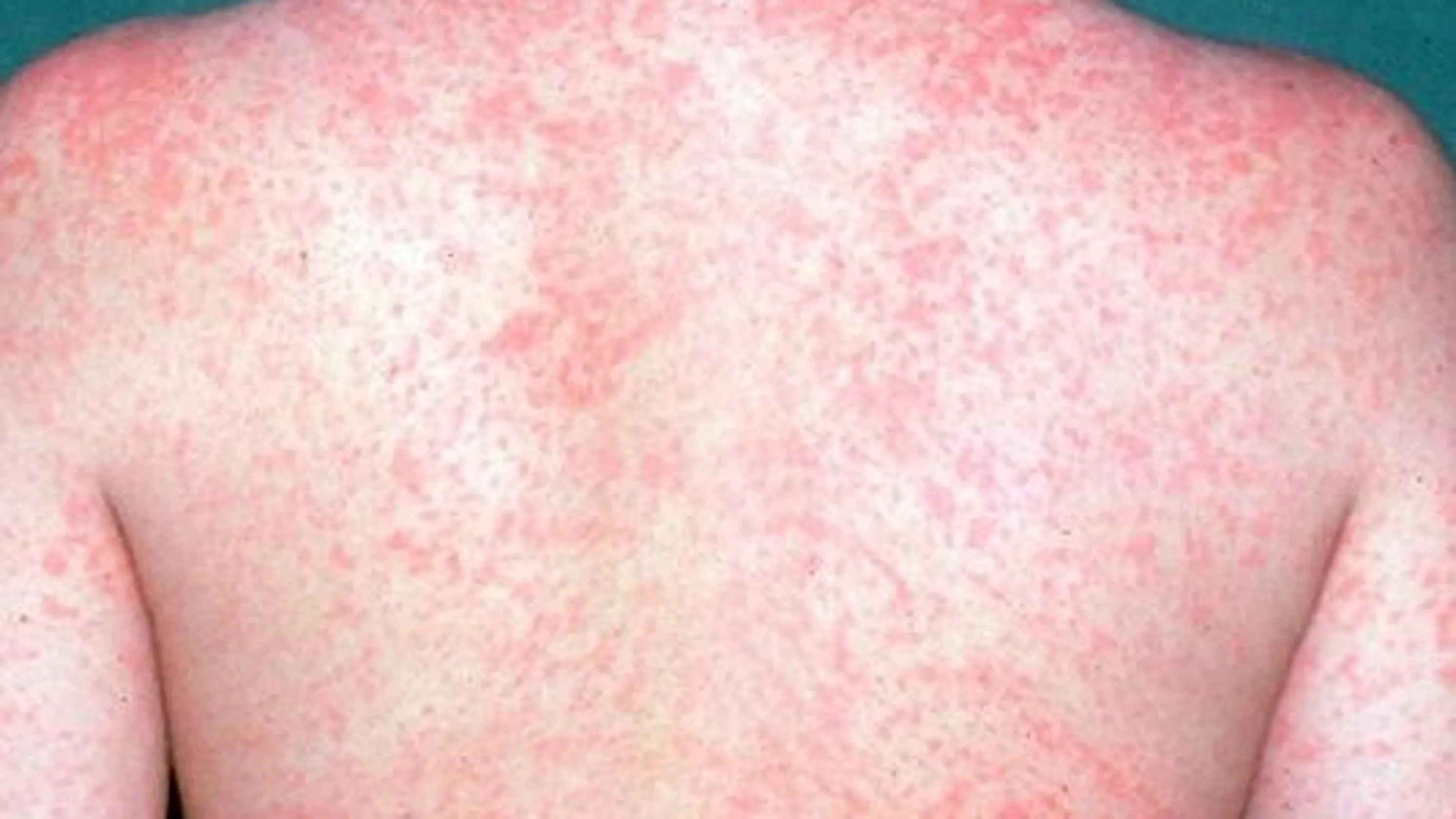 <p>A patient comes in with a strong cough and reddish, swollen eyes. The young patient has little white spots in her mouth and a fever of 101.3*F. The patient also is starting to have a rash all around her body that looks like the picture. What disease do you think the patient has?</p><p>a. Varicella Zoster</p><p>b. Scarlet Fever</p><p>c. Measles</p><p>d. Mononucleosis</p>