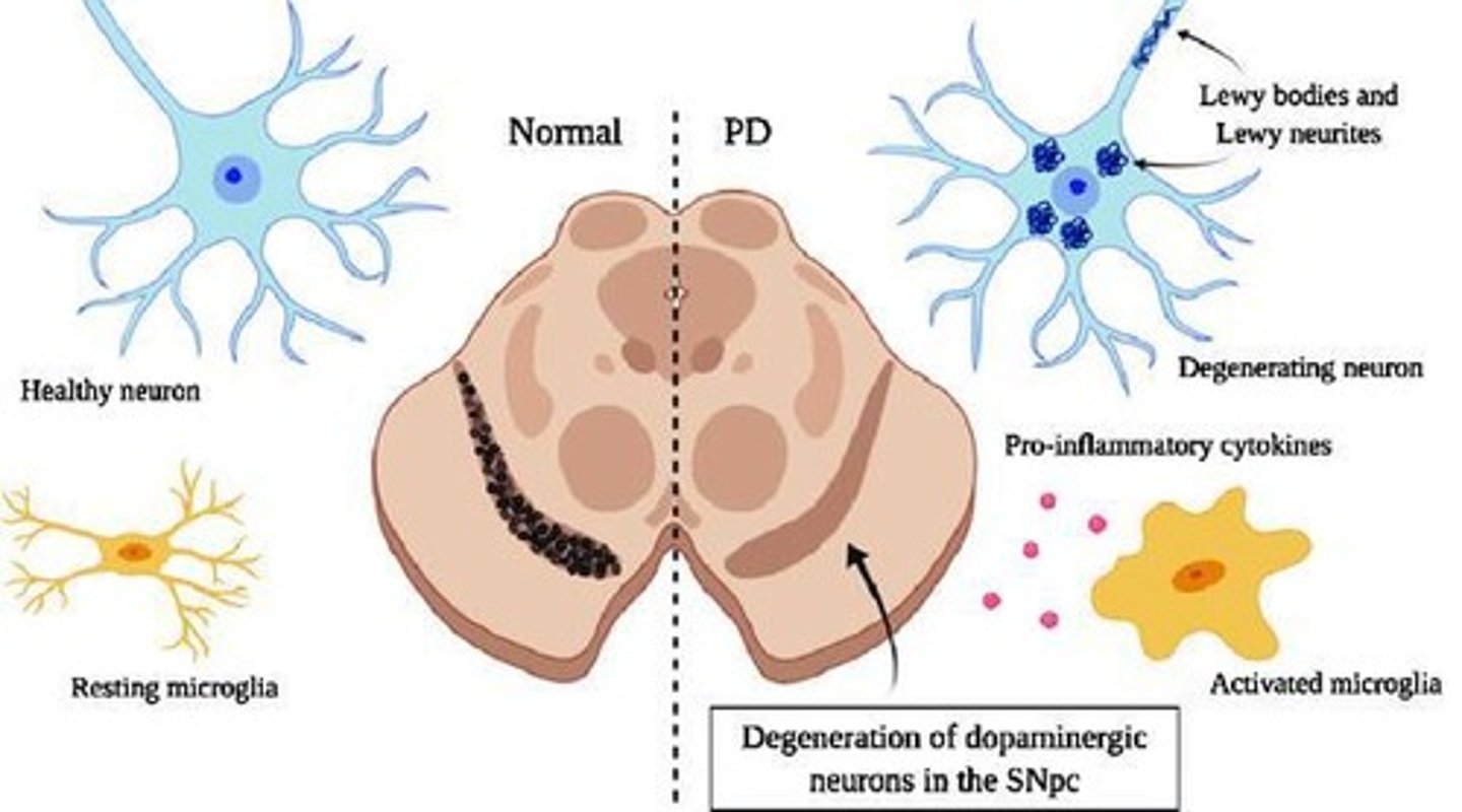 <p>Lewy bodies are aggregates formed from a-synuclein protein.</p>