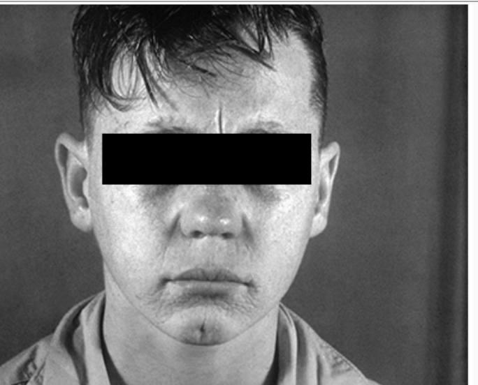 <p>Adolescente com sífilis congênita. Qual a alteração evidenciada na imagem?</p>