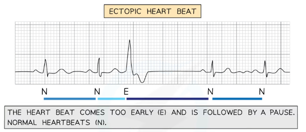 <ul><li><p>early heartbeat followed by a pause</p></li></ul>