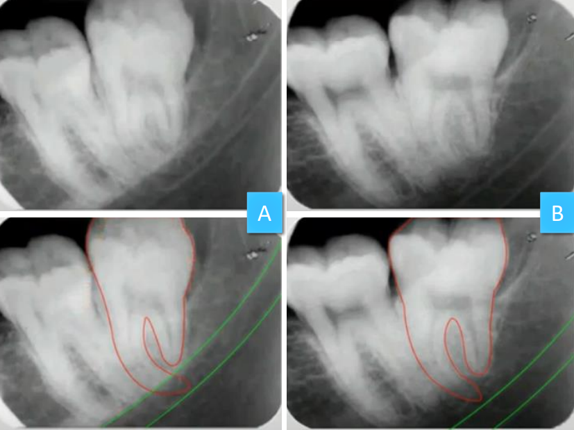 <p>where is the mandibular canal relative to the apices of #17</p>