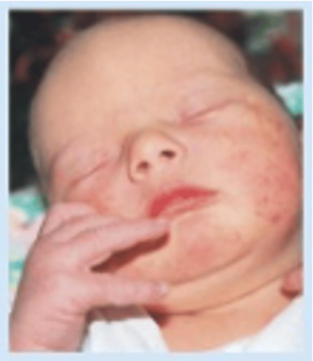 <p>usually appears on days 2-3 of life</p><p>erythematous macules with central pinpoint vesicles scattered diffusely over entire body</p><p>appears similar to flea bites</p><p>cause unknown</p><p>disappear within 1st week</p>