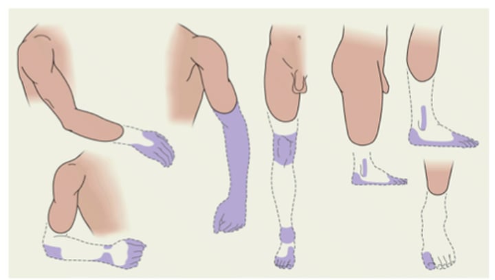 <p>sensations that appear to originate in a limb that has been amputated after an amputation, the person continues to experience the felt presence of the amputated limb. what happens is the region of the parietal lobe that normally receives signals from the amputated limb is no longer getting that input so neurons form connections with neurons in adjacent regions of the body map and because of this neuroplastic reorganization, the phantom limb is born.</p>