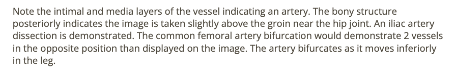 <p>c) iliac artery dissection</p>