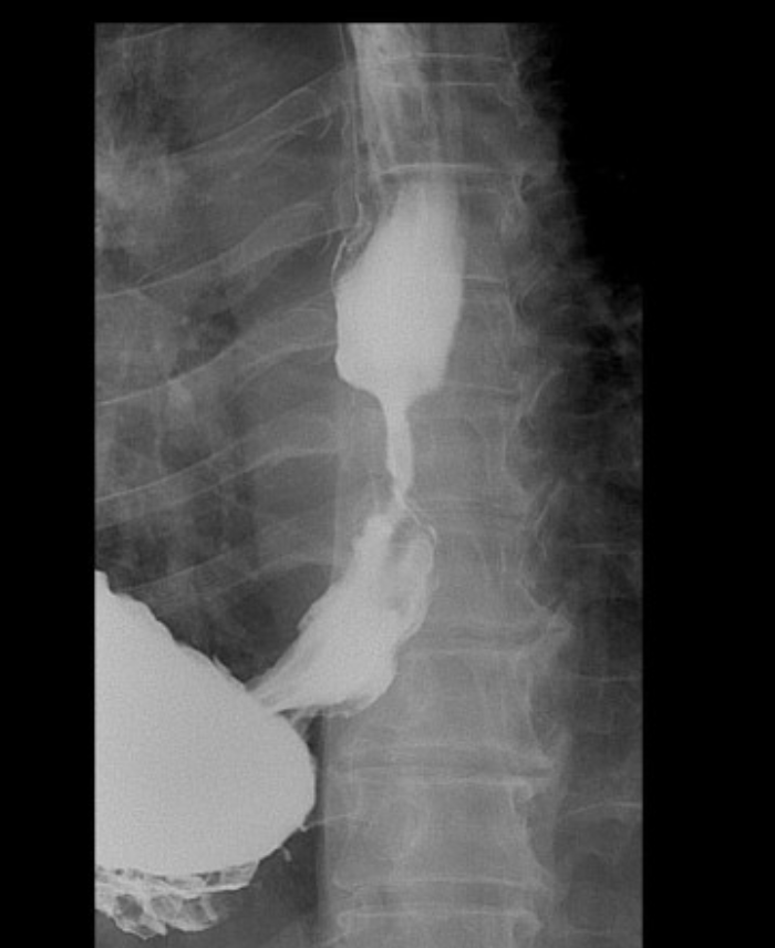 <p>67 y/o patient presents to the clinic for his 1st check up in years. PMX is positive for GERD, which he states that he doesn’t have any more. He does report that recently he has had trouble eating solid foods, but liquids are good. Barium swallow study and endoscopy diagnose a stricture. What is your treatment plan?</p>