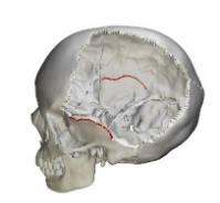 <p>Unites parietal and temporal bones</p>