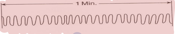 <p>What type of breathing is this?</p>