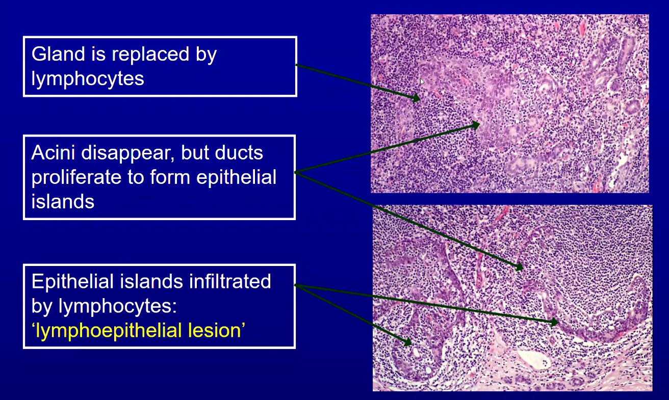 <p><span>Gland is replaced by Lymphocytes</span><br><br><span>Acini Disappear but Ducts proliferate to form Epithelial Islands forming Lympho-epithelial lesions</span></p>
