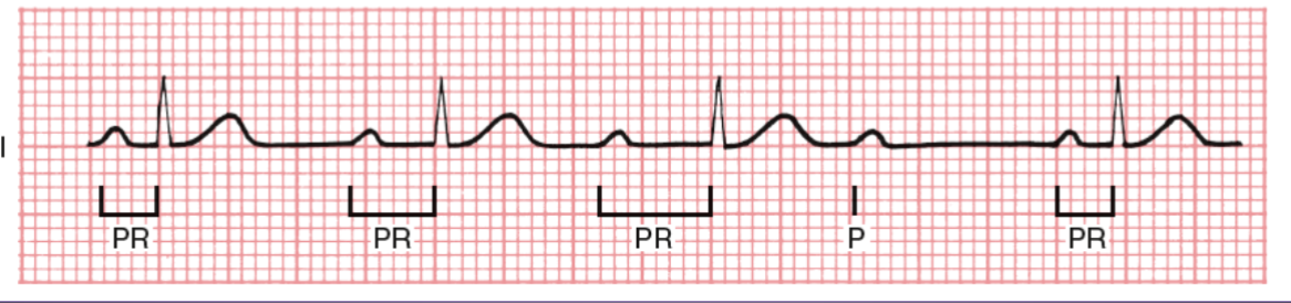 <p><span>AV block in which signal has PROGRESSIVE difficulty traversing the AV node, dropped QRS</span></p>