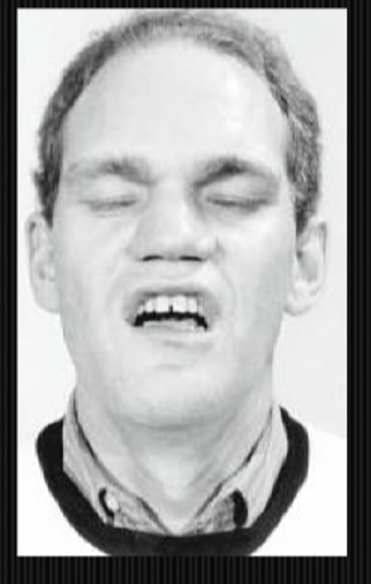 <p>CN 7 palsy may cause unilateral drooping mouth</p><p>MG snarl when orbicularis oris fatigues and mouth corners cannot raise</p><p>hemifacial spasm = involuntary twitching or contraction of the facial muscles on one side of the face</p>