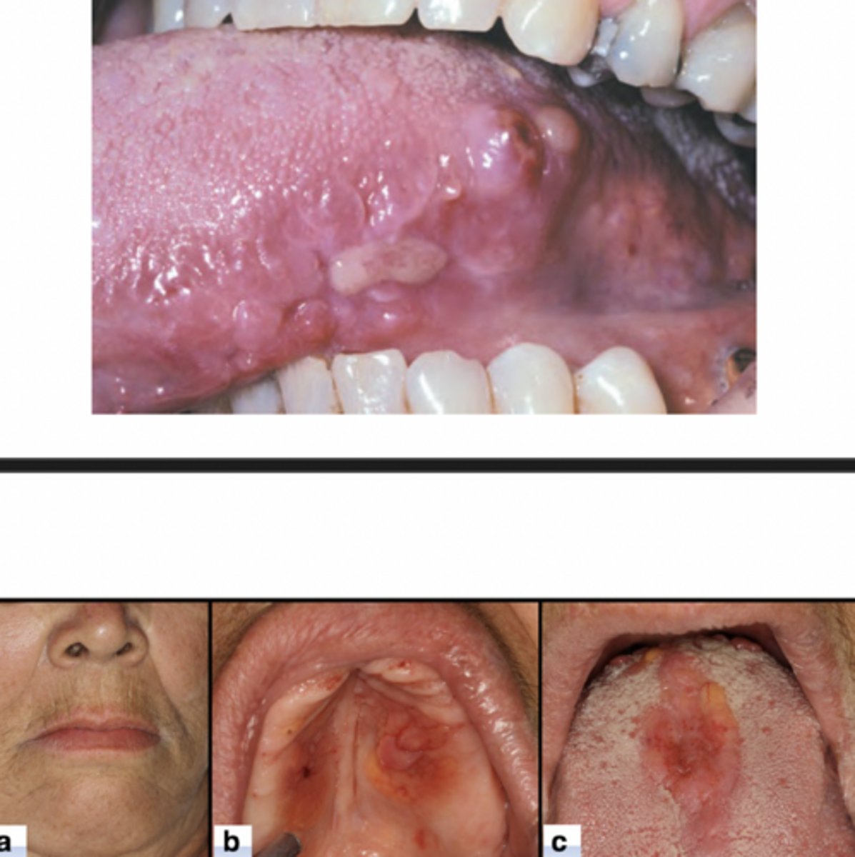 <p>-macroglossia - diffuse or nodular enlargement</p><p>-may show ulceration or submucosal hemorrhage</p><p>-rare xerostomia</p>