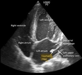 <p><strong>a part of the left atrium that lies between the left atrial appendage</strong></p>