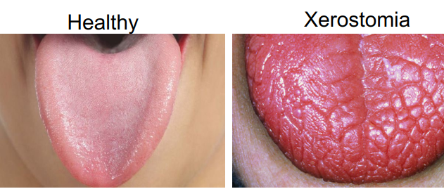 <p>Dry mouth </p><ul><li><p>caused by decrease in salivary flow or absent. </p></li></ul><p>Decreased salivary flow = increase in bacteria, calculus increase, increased periodontal disease progression </p>