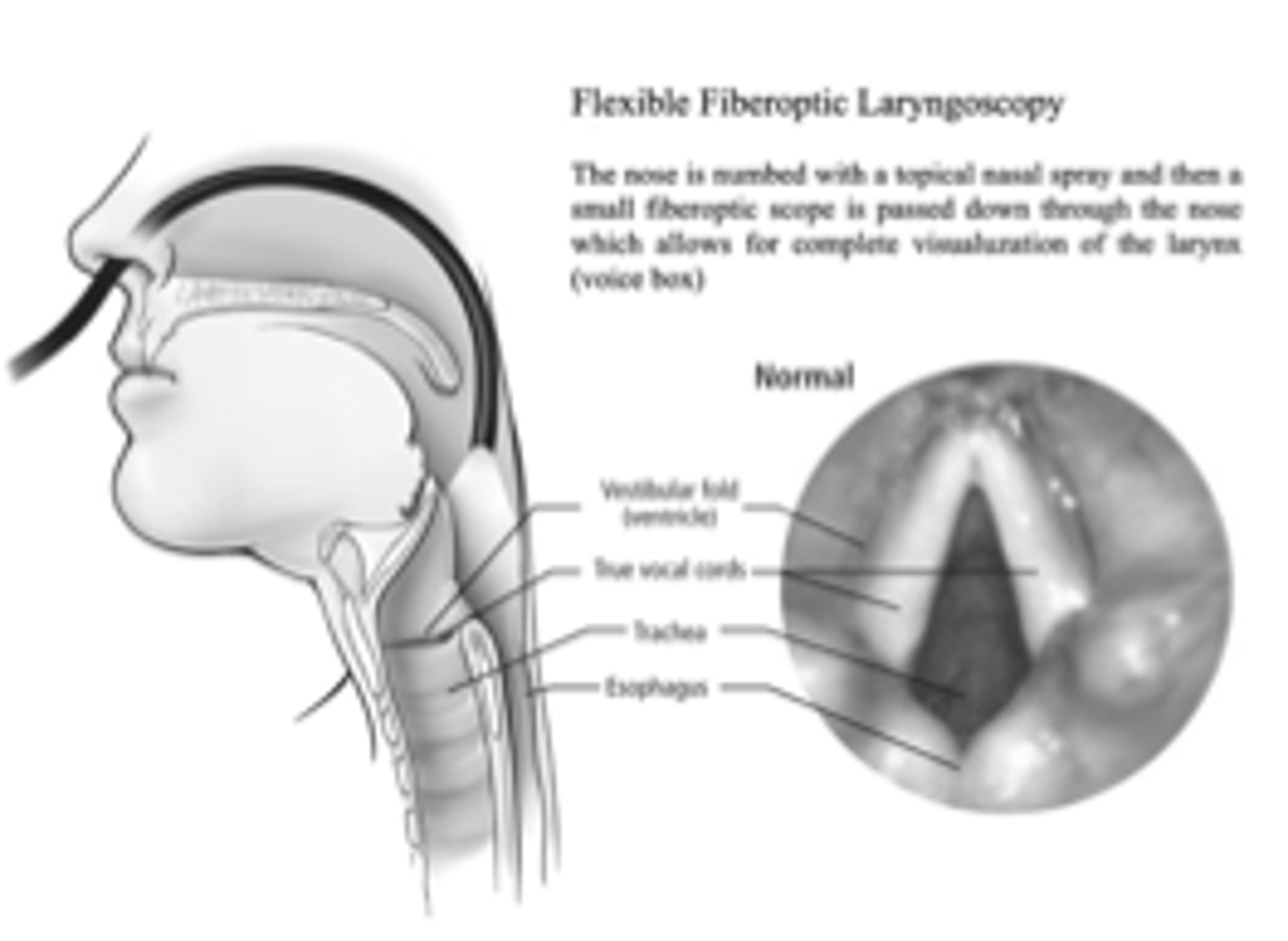 <p>view the vocal folds from above via the nasal cavity- also measures swallowing</p>