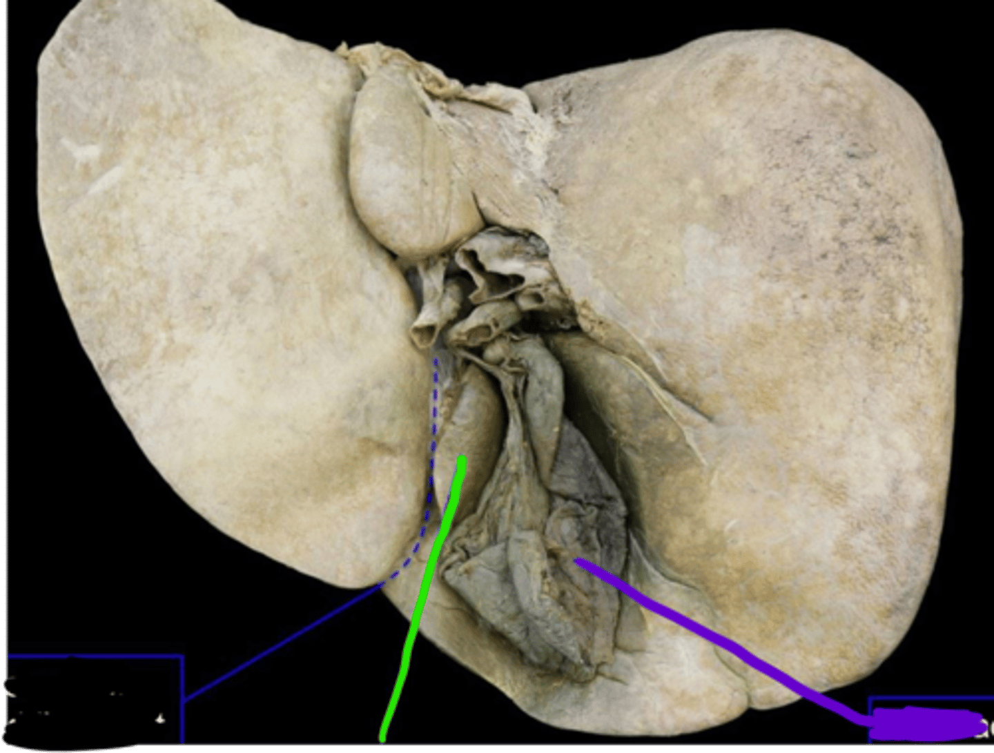 <p>Depression</p><p>Bottom left 1/2 of H</p>