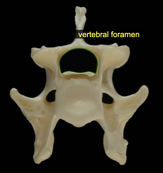 <p>Large passageway for the spinal cord seen in each vertebra</p>