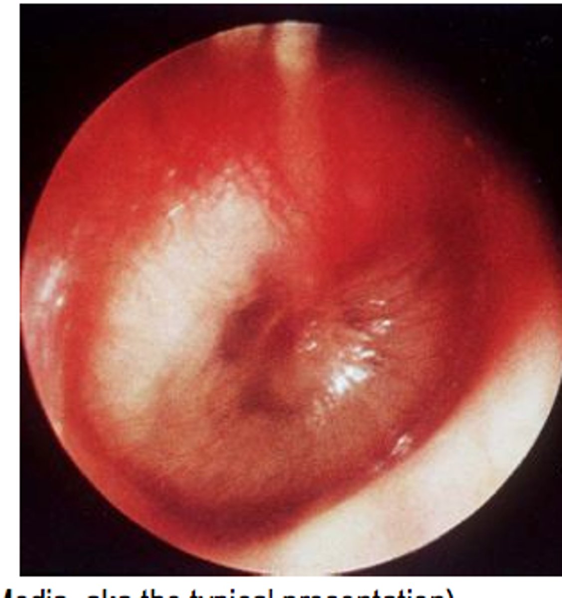 <p>Red, bulging, decreased light reflex</p>