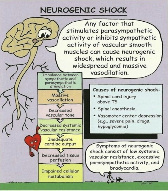 <p>Loss of muscle tone in blood vessel walls below the level of injury due to loss of communication within sympathetic nervous system. (<em>affects the nervous system and is usually sustained</em>)</p><ul><li><p><strong>Clinical Manifestations</strong>:</p><ul><li><p>Hypotension</p></li><li><p>Bradycardia</p></li><li><p>↓ cardiac output ⟶ dependent edema, <span style="color: yellow">peripheral vasodilation, venous pooling</span></p></li><li><p>Loss of temperature regulation</p></li></ul></li><li><p>Greater risk of developing venous thromboembolism (VTE)</p></li><li><p><strong>Treatment</strong>: Vasopressors or atropine, IV fluids</p></li></ul><div data-type="horizontalRule"><hr></div><ul><li><p>Loss of temperature regulation - no sweating d/t sympathetic activity</p></li><li><p>Risk for abrupt onset of fever</p></li><li><p>Distributive shock - mass vasodilation → ↓ systemic vascular resistance → ABNORMAL DISTRIBUTION of blood flow → inadequate blood supply to tissues &amp; organs</p></li></ul><p>*T6 or above</p>