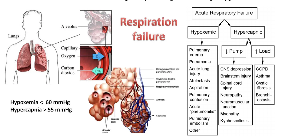 <p>Det uppstår vid svikt i det respiratoriska systemet:</p><ul><li><p><strong>Ventilation-perfusionrubbning</strong>: perfusionen och ventilationen matchar inte. </p><ul><li><p>KOL: för lite gasutbyte pga emfysem. </p></li><li><p>Atelektas: blodet syresätts inte vid kollapsad lunga. </p></li><li><p>Lungemboli: ingen perfusion. </p></li></ul></li><li><p><strong>Diffusionshinder (→hypoxi)</strong>: Kallas även lungsvikt eftersom gasutbytet inte kan ske. </p></li><li><p><strong>Alveoler hypoventilation (→ hyperkapne)</strong>: Kallas även pumpsvikt där luften inte kan ventileras. </p></li></ul>