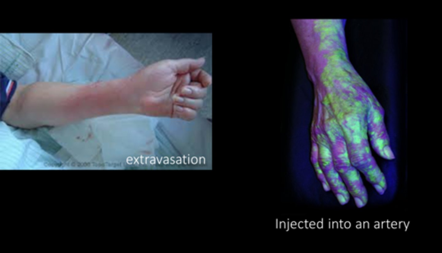 <p>inject a small amount of NaFl to look for...</p><p>1. pain/burning = needle is in artery or extravascular tissue, pH 9 of NaFl burns</p><p>2. extravasation = site discoloration, edema</p><p>3. yellowing distal to injection site = artery injection</p>