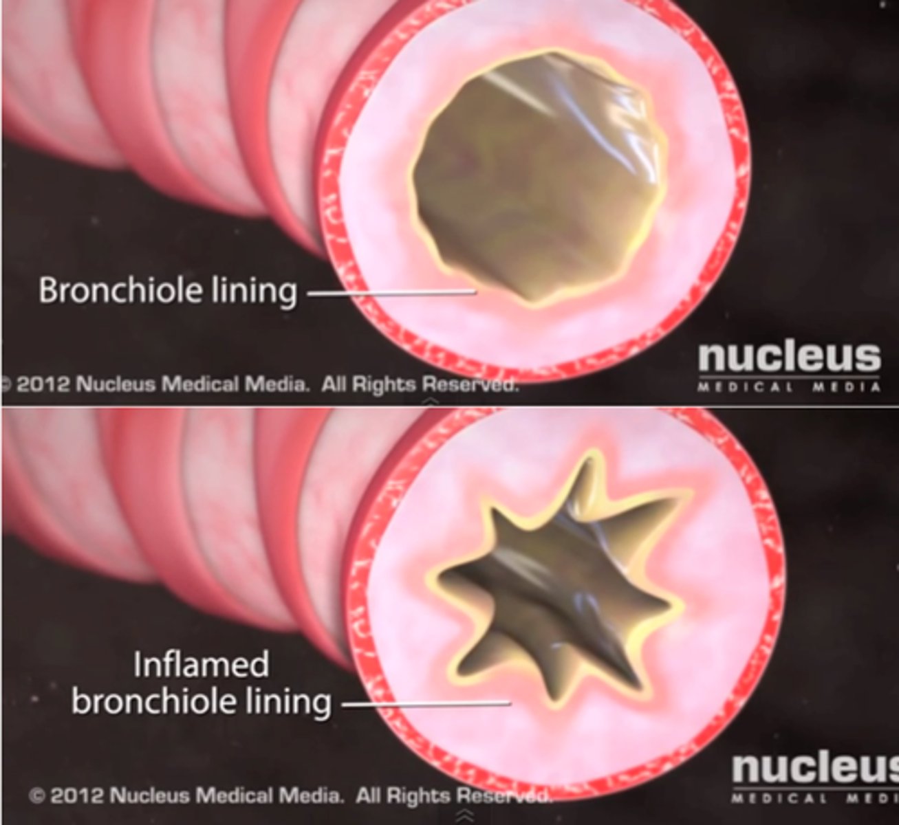 <p>A lung disease characterized by inflamed, narrowed airways and difficulty breathing.</p>