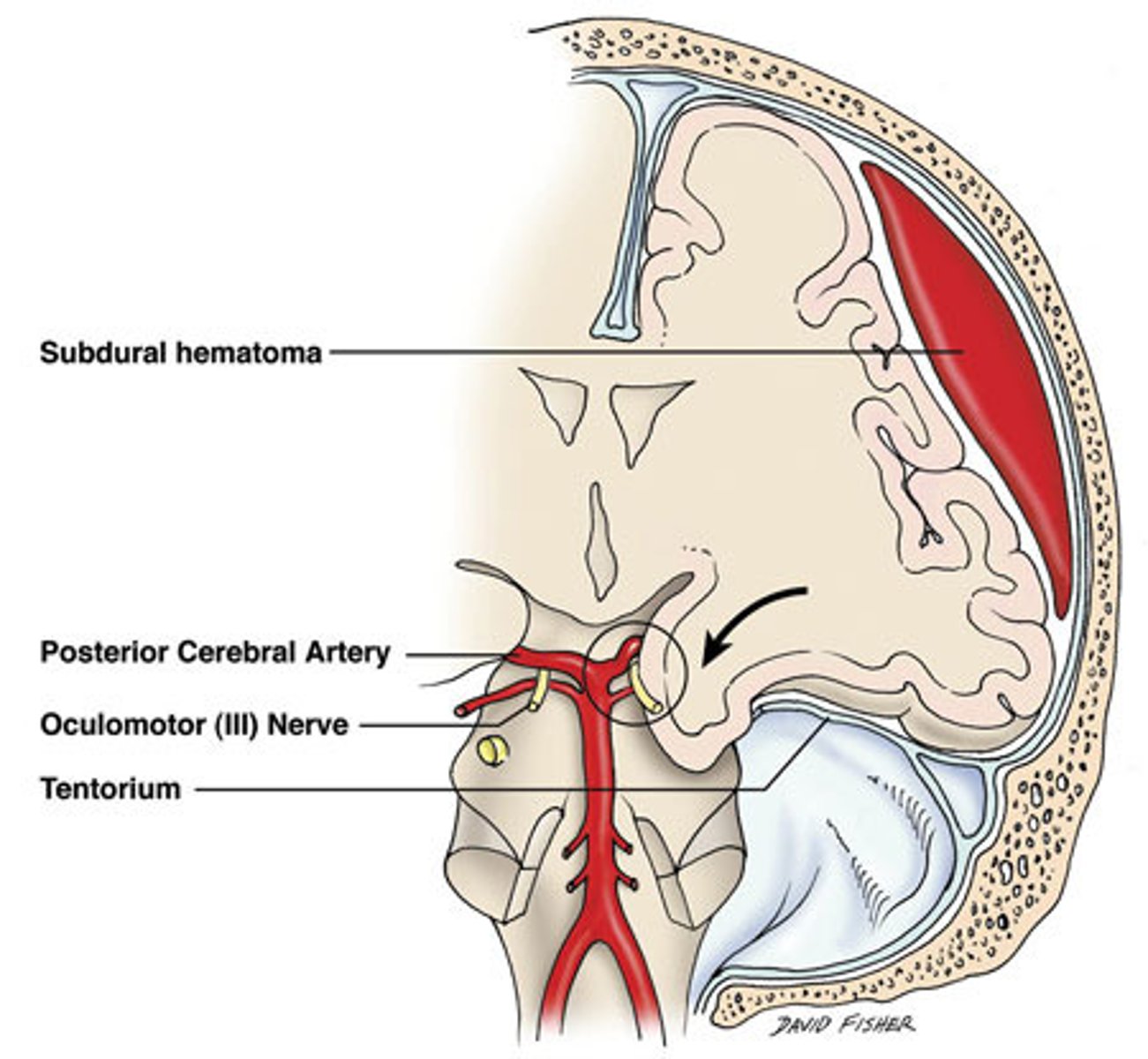 <p>Define Brain Herniation:</p><p>Leads to...</p><p>-CN3 compression (ipsilateral pupillary dilation)</p><p>-PCA compression (visual cortex ischemia)</p><p>-Contralat cerebral peduncle compression (Hemiparesis)</p><p>-Blood vessel shearing (Duret Hemorrhages in midbrain &amp; pons)</p>