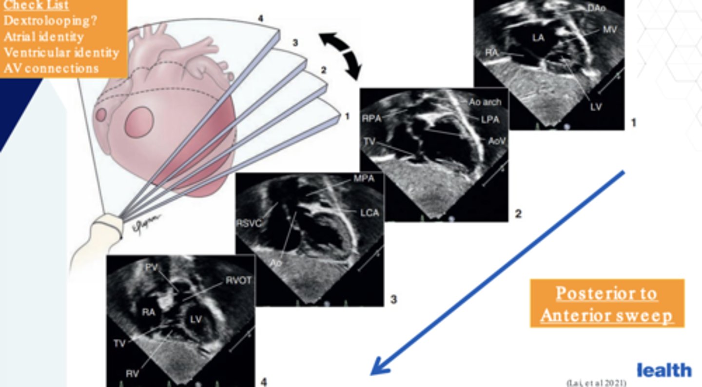 <p>Dextrolooping, atrial identity, ventricular identity, AV connections</p>