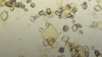 <ol start="68">
<li>What are uric acid crystals</li>
</ol>