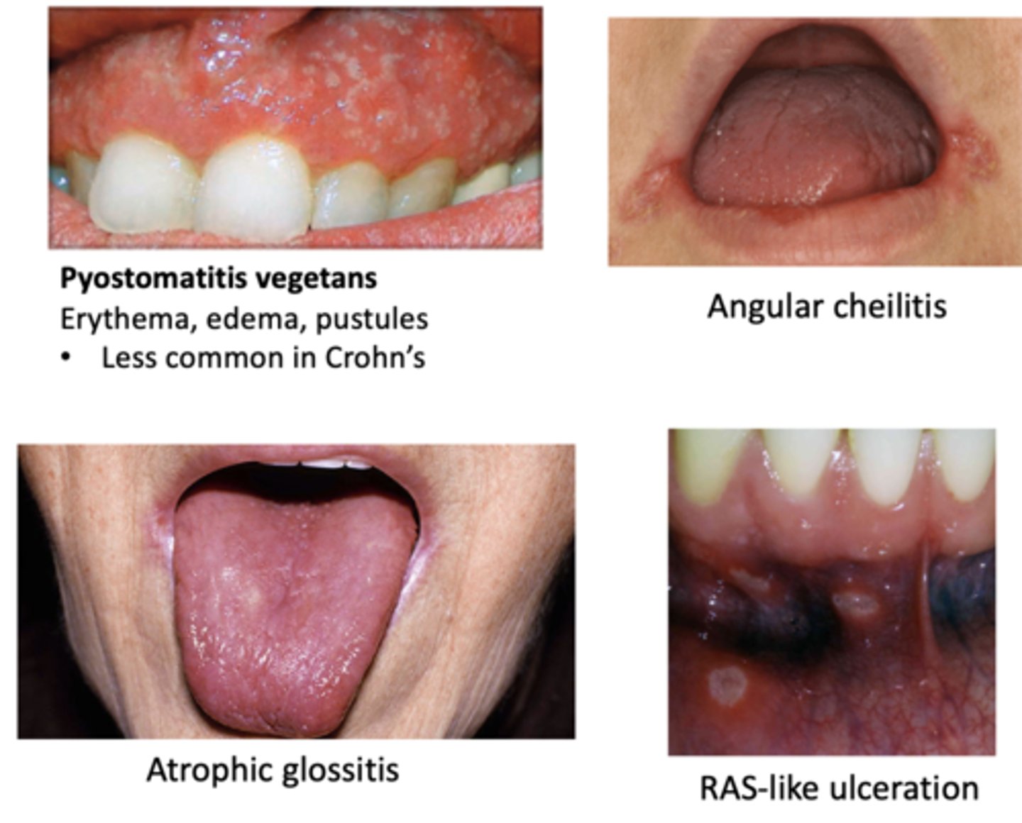 <p>Oral manifestations of this GI disease include:</p><p>- Pyostomatitis vegetans (Erythema, edema, pustules) </p><p>- RAS-like ulceration</p><p>- Angular cheilitis</p><p>- Atrophic glossitis</p>