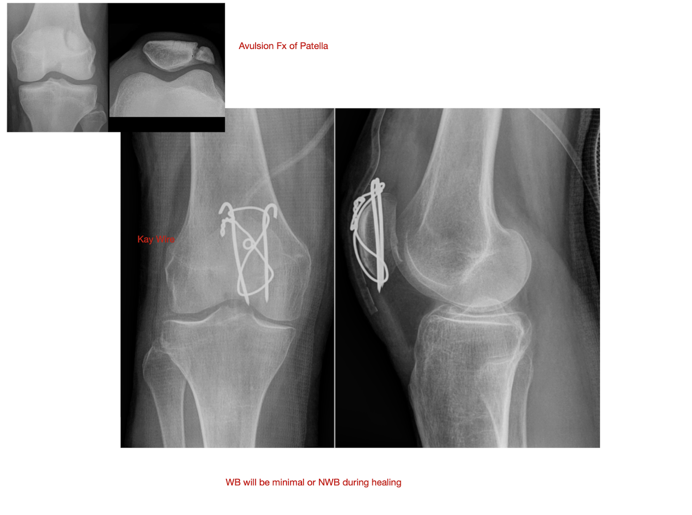 <p>Avulsion Fx of the Patella </p><p></p><p>» Flip «</p>