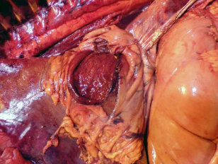 <p>How can you tell this gastric perforation occurred before or after death?</p>