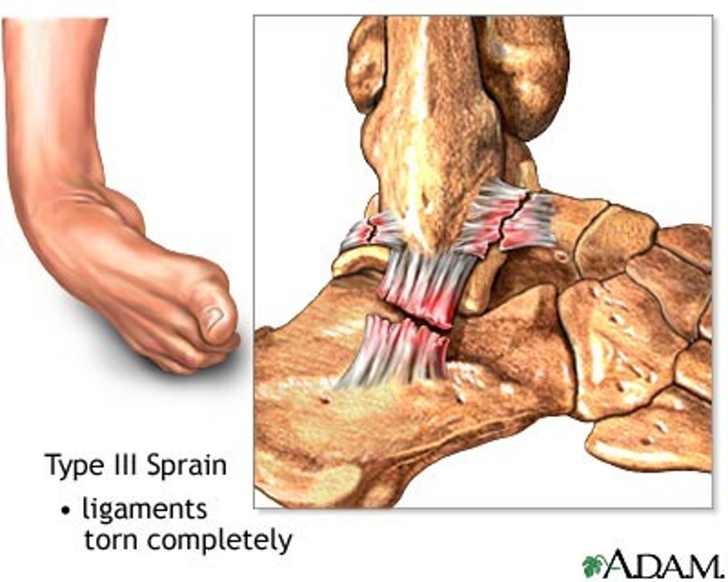 <p>What is the twisting of joint that stretches or tears ligaments, no dislocation, damage to nearby blood vessels (swelling & hemorrage), muscles & tendons?</p>