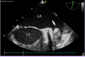 <p>Caused by stasis of blood within the cavity.</p><p>Most common location for atrial thrombus.</p><p>Often not seen with TTE; TEE used in patients with CVA.</p>