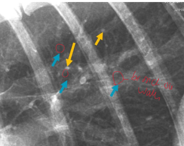 <ul><li><p>bronchi look like donuts if cut transversely or train tracks if cut longitudinally</p></li><li><p>we see bronchi more clearly in the periphery</p></li></ul><p>why =  wall becomes mineralised (opacity is more white) and therefore easier to see/wall becomes thicker and is easier to see </p><p></p>