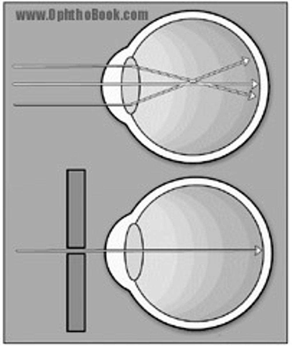 <p>Pinhole test; to see if the observed decrease in acuity was caused by a refractive error</p><p>Expect an improvement in visual acuity by at least one line on the chart if refractive error is responsible for the diminished acuity</p>