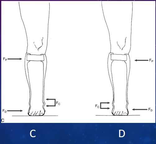 <p>Which of these shows that to control inversion (varus) of foot &amp; ankle, Fd is applied by distal medial wall of orthosis against 1st metatarsal, Fp at the proximal medial calf band, &amp; Fc at distal lateral tibia &amp; calcaneus/talus on either side of lateral malleolus?</p>