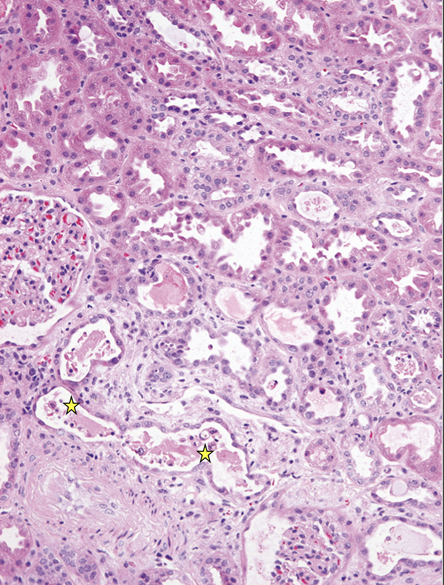 <p>What pathology is indicated? What is shown at the yellow stars?</p>